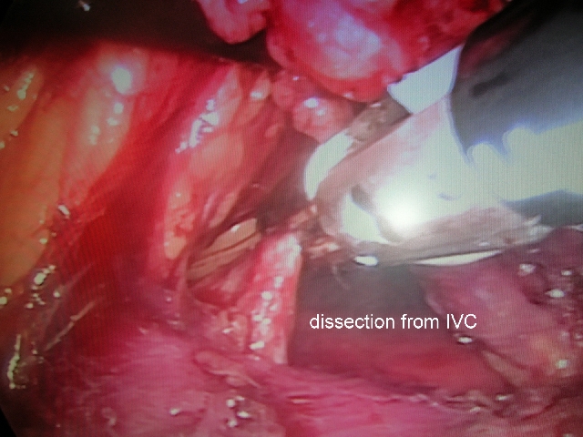 DISSECTION FROM IVC